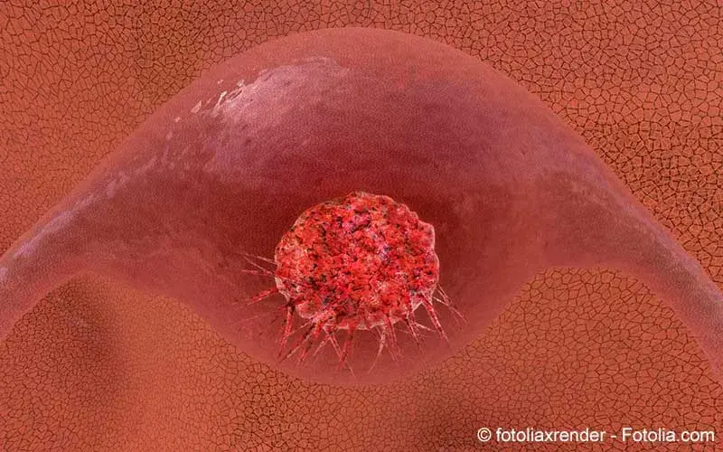 Gebärmutterhalskrebs