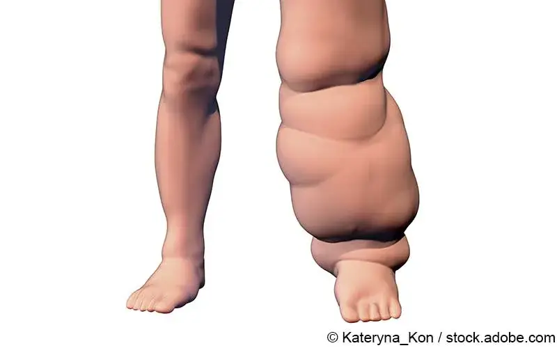 Was ist Elephantiasis tropica? Was hilft gegen Elephanten-Krankheit? |  Meine Gesundheit