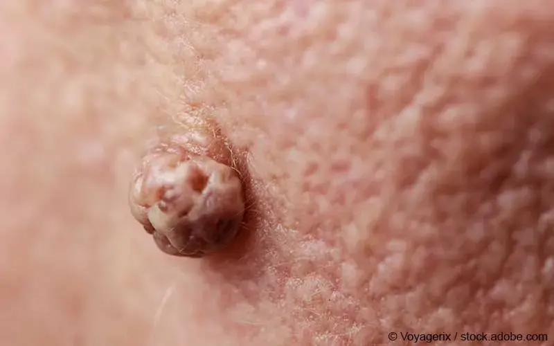 Talgzyste intimbereich