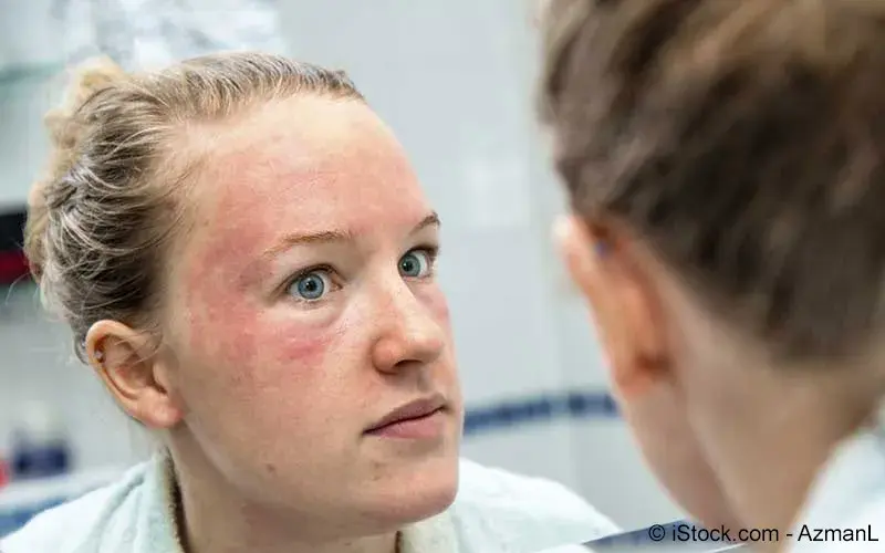 gurtelrose ursachen symptome behandlung meine gesundheit