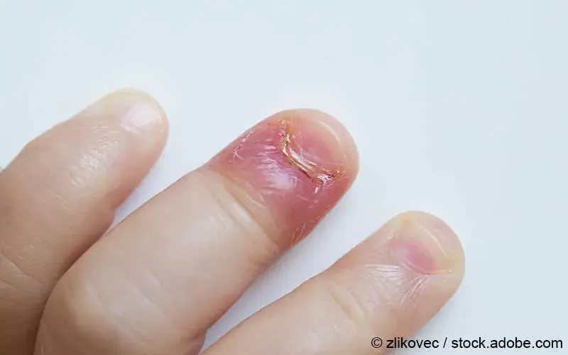 hndedesinfektionsmittel mit aloe vera Desinfektion mit Aloe Vera- Spray