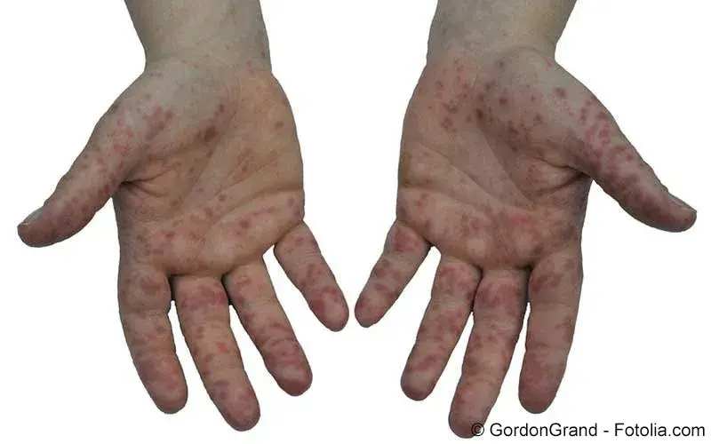 Allergie und Unvertrglichkeit | Meine Gesundheit