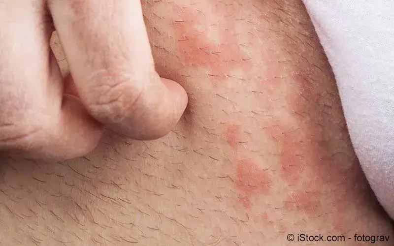Kontaktallergie | Meine Gesundheit Kontaktallergie | Meine Gesundheit