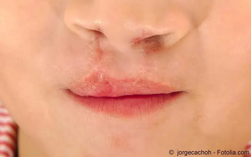 Lippen-Kiefer-Gaumenspalte | Meine Gesundheit Lippen-Kiefer-Gaumenspalte | Meine Gesundheit