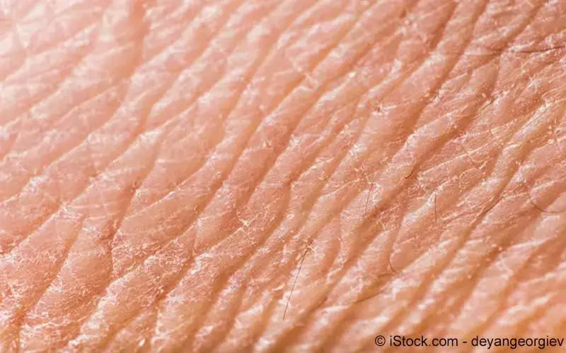 Trockene haut nase extrem Burnout: Symptome,