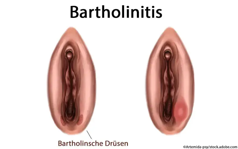 Was passiert wenn man Bartholinitis nicht behandelt?