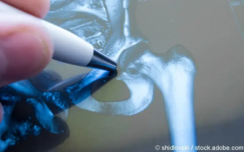 Was tun bei Hüftarthrose?