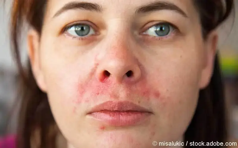 Isotretinoin nach absetzen der pille